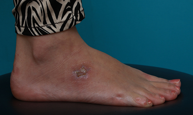 刺青（タトゥー）除去,足の小さな入れ墨を剥削手術で除去した症例写真,3週間後,mainpic_irezumi15e.jpg