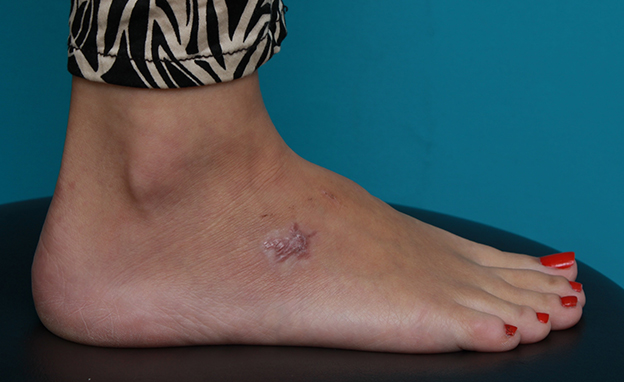 症例写真,足の小さな入れ墨を剥削手術で除去した症例写真,2ヶ月後,mainpic_irezumi15f.jpg