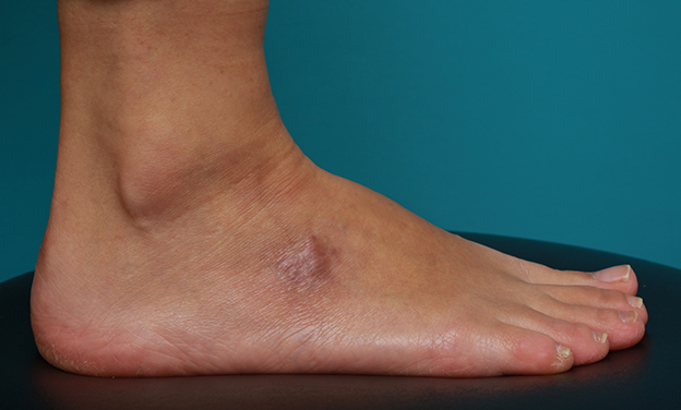 刺青（タトゥー）除去,足の小さな入れ墨を剥削手術で除去した症例写真,6ヶ月後,mainpic_irezumi15g.jpg