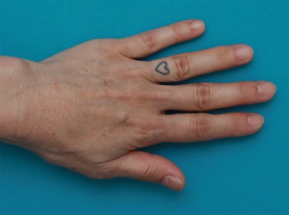 刺青（タトゥー）除去,指に入れた入れ墨を剥削手術で除去した症例写真,Before,ba_irezumi29_b.jpg