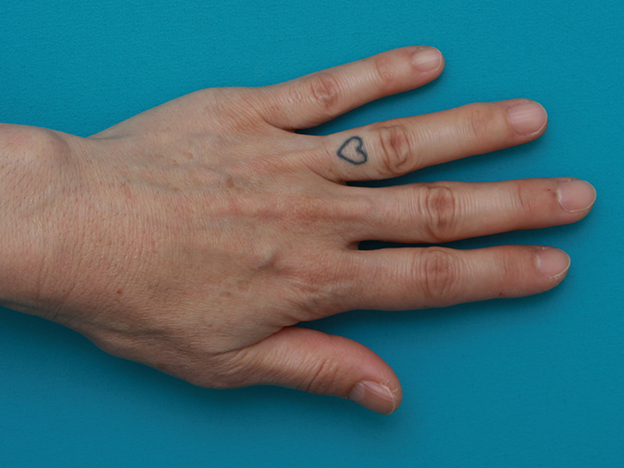 刺青（タトゥー）除去,指に入れた入れ墨を剥削手術で除去した症例写真,手術前,mainpic_irezumi16a.jpg