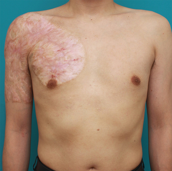 刺青（タトゥー）除去,胸~肩~上腕にかけての広範囲の刺青を3回に分けて剥削手術で除去した症例写真,After（3回目手術後2年）,ba_irezumi30_a01.jpg