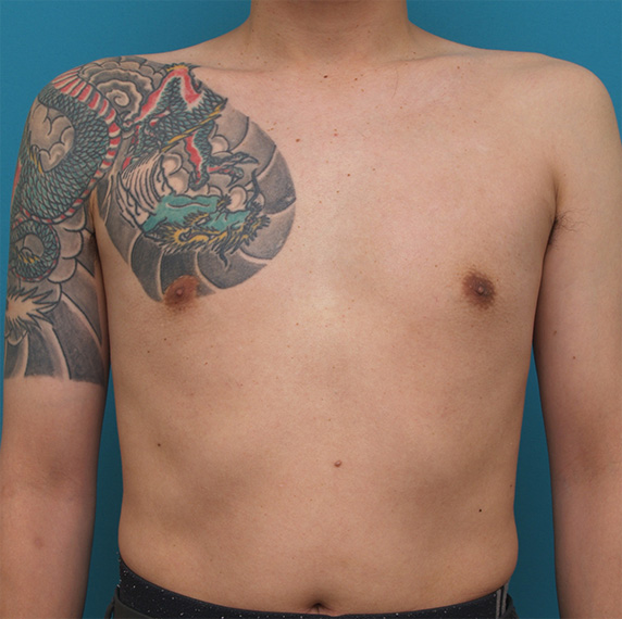 胸~肩~上腕にかけての広範囲の刺青を3回に分けて剥削手術で除去した症例写真,Before,ba_irezumi30_b.jpg