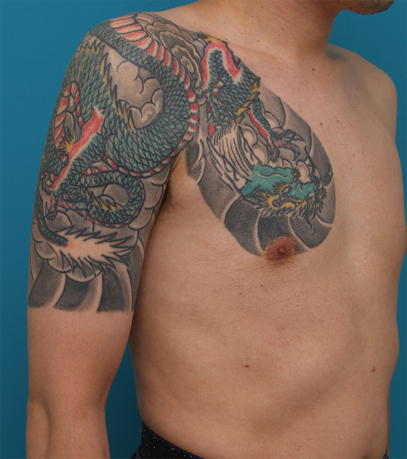 刺青（タトゥー）除去,胸~肩~上腕にかけての広範囲の刺青を3回に分けて剥削手術で除去した症例写真,Before,ba_irezumi31_b.jpg