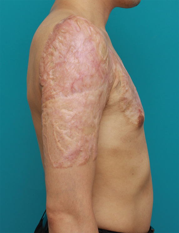 刺青（タトゥー）除去,胸~肩~上腕にかけての広範囲の刺青を3回に分けて剥削手術で除去した症例写真,After（3回目手術後2年）,ba_irezumi32_b.jpg