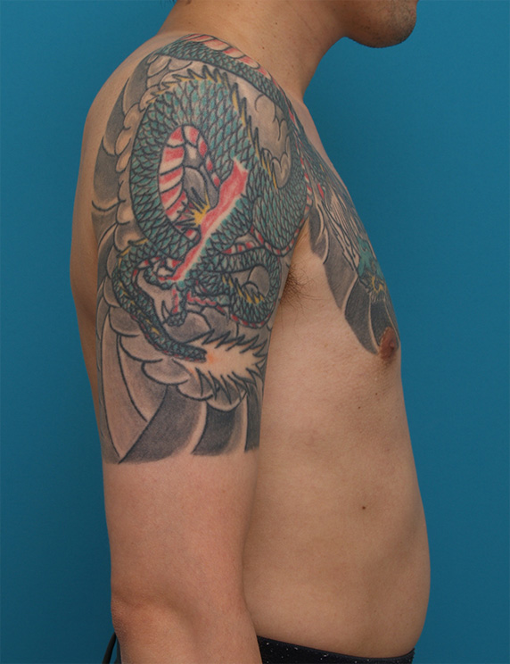 刺青（タトゥー）除去,胸~肩~上腕にかけての広範囲の刺青を3回に分けて剥削手術で除去した症例写真,Before,ba_irezumi32_b.jpg