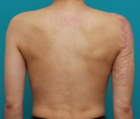 症例写真,胸~肩~上腕にかけての広範囲の刺青を3回に分けて剥削手術で除去した症例写真,After（3回目手術後2年）,ba_irezumi33_b.jpg