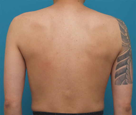 刺青（タトゥー）除去,胸~肩~上腕にかけての広範囲の刺青を3回に分けて剥削手術で除去した症例写真,Before,ba_irezumi33_b.jpg
