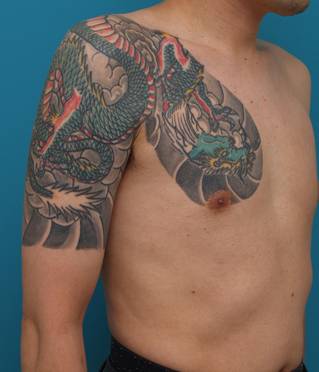 刺青（タトゥー）除去,胸~肩~上腕にかけての広範囲の刺青を3回に分けて剥削手術で除去した症例写真,手術前,mainpic_irezumi17a.jpg