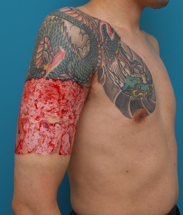 刺青（タトゥー）除去,胸~肩~上腕にかけての広範囲の刺青を3回に分けて剥削手術で除去した症例写真,1回目手術直後,mainpic_irezumi17b.jpg