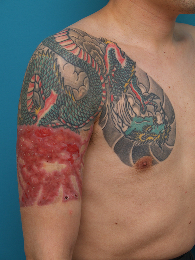 刺青（タトゥー）除去,胸~肩~上腕にかけての広範囲の刺青を3回に分けて剥削手術で除去した症例写真,1回目手術後3ヶ月,mainpic_irezumi17d.jpg