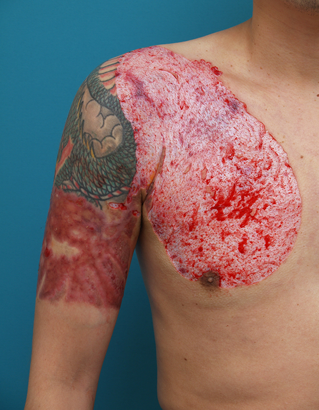 刺青（タトゥー）除去,胸~肩~上腕にかけての広範囲の刺青を3回に分けて剥削手術で除去した症例写真,2回目手術直後,mainpic_irezumi17e.jpg