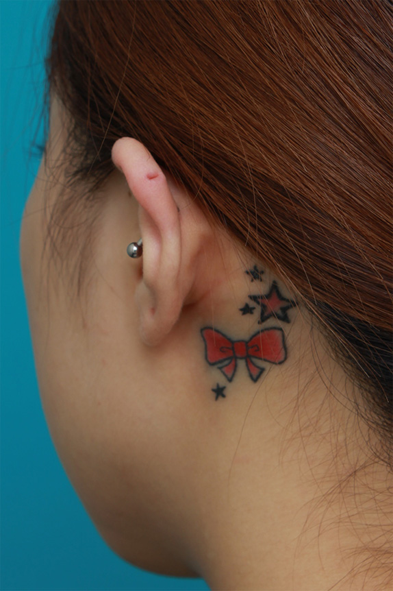刺青（タトゥー）除去,耳の後ろの入れ墨を部分的に切除縫縮手術して除去した症例写真,Before,ba_irezumi34_b.jpg