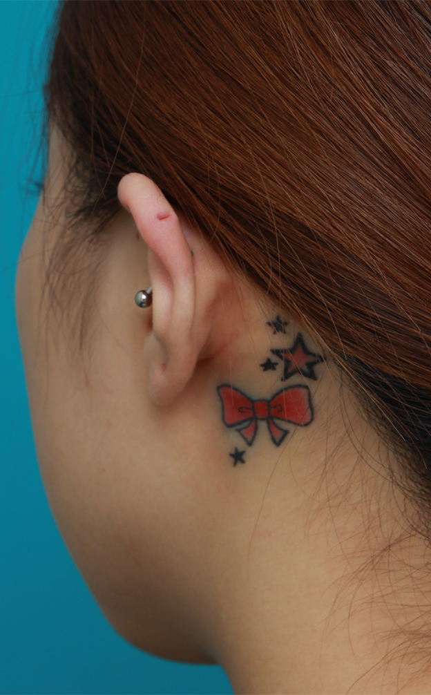 刺青（タトゥー）除去,耳の後ろの入れ墨を部分的に切除縫縮手術して除去した症例写真,手術前,mainpic_irezumi18a.jpg