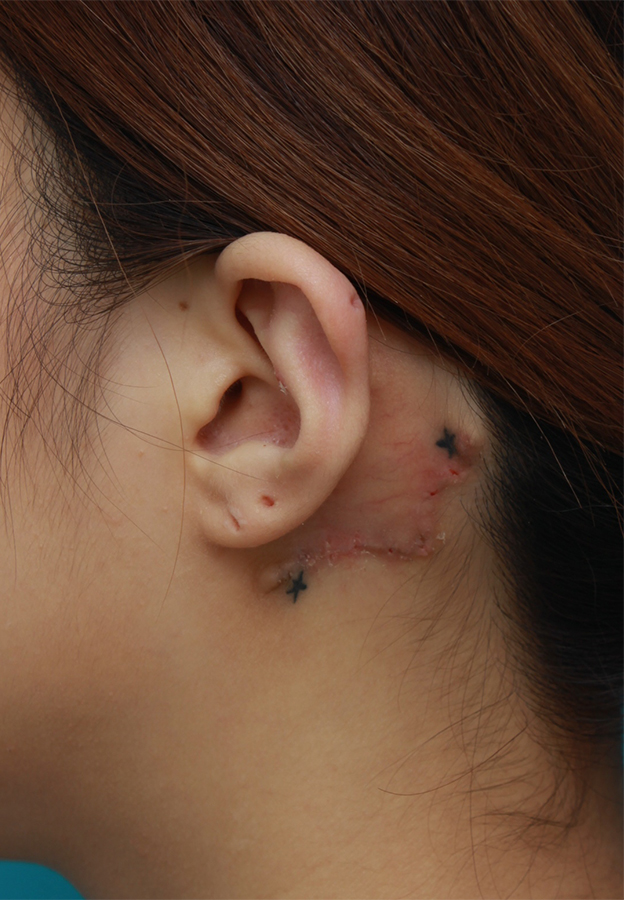 刺青（タトゥー）除去,耳の後ろの入れ墨を部分的に切除縫縮手術して除去した症例写真,1週間後,mainpic_irezumi18c.jpg