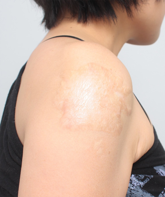刺青（タトゥー）除去,肩の大きな入れ墨を剥削手術（削って消す治療）で一回で除去した症例写真,After（2年8ヶ月後）,ba_irezumi35_a01.jpg