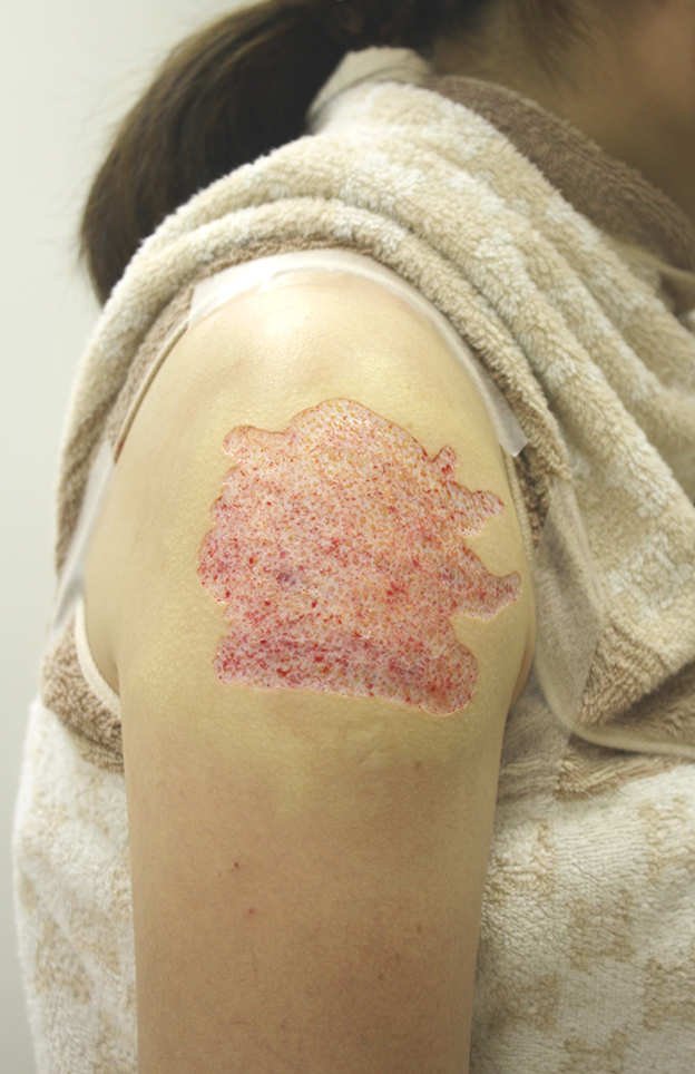 刺青（タトゥー）除去,肩の大きな入れ墨を剥削手術（削って消す治療）で一回で除去した症例写真,手術直後,mainpic_irezumi19b.jpg