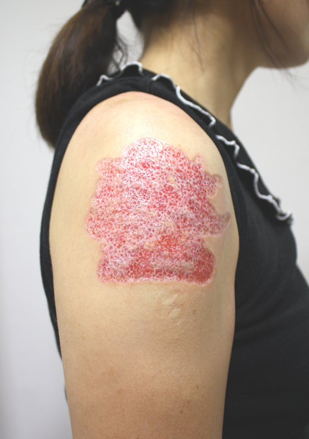 刺青（タトゥー）除去,肩の大きな入れ墨を剥削手術（削って消す治療）で一回で除去した症例写真,1週間後,mainpic_irezumi19c.jpg