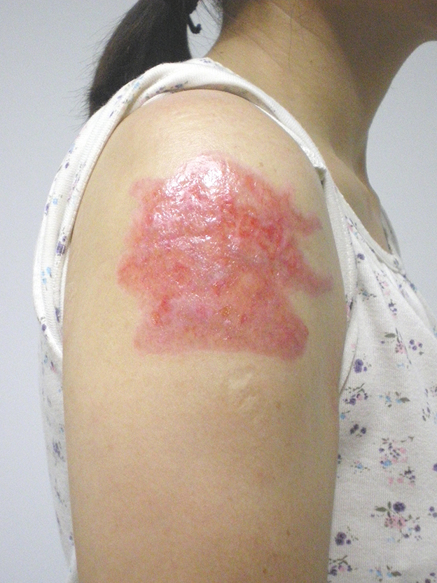 刺青（タトゥー）除去,肩の大きな入れ墨を剥削手術（削って消す治療）で一回で除去した症例写真,1ヶ月後,mainpic_irezumi19d.jpg