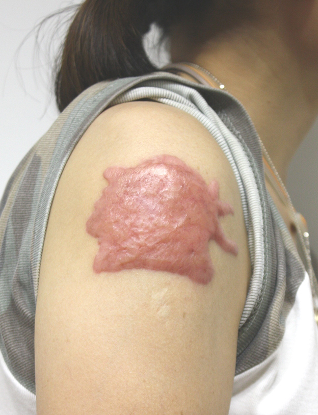 刺青（タトゥー）除去,肩の大きな入れ墨を剥削手術（削って消す治療）で一回で除去した症例写真,3ヶ月後,mainpic_irezumi19e.jpg