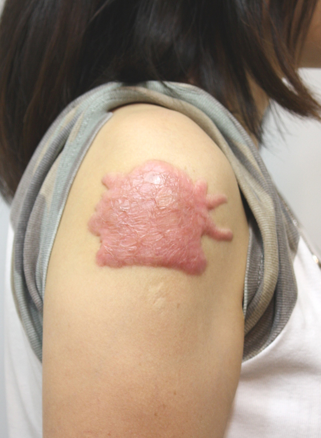 刺青（タトゥー）除去,肩の大きな入れ墨を剥削手術（削って消す治療）で一回で除去した症例写真,6ヶ月後,mainpic_irezumi19f.jpg