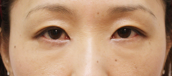 目頭切開の症例 目と目の間隔が広いことを気にして来院された女性,After,ba_megashira12_a01.jpg