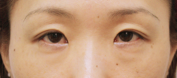 症例写真,目頭切開の症例 目と目の間隔が広いことを気にして来院された女性,Before,ba_megashira12_b.jpg
