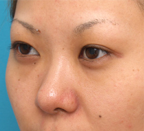 隆鼻術（シリコンプロテーゼ）,目頭切開の症例　隆鼻術（シリコンプロテーゼ）も施行,Before,ba_megashira18_b.jpg