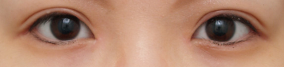 症例写真,目頭切開の症例 Z法で蒙古ひだを切開しひと回り目を大きくした女性,After（1ヶ月後）,ba_megashira14_b.jpg