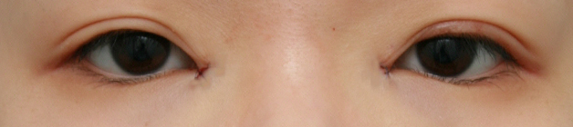 症例写真,目頭切開の症例 Z法で蒙古ひだを切開しひと回り目を大きくした女性,施術直後,mainpic_megashira01b.jpg