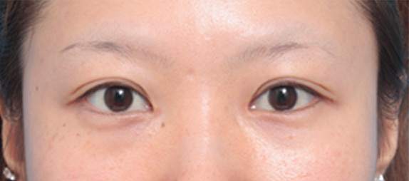 目頭切開,目頭切開の症例 蒙古襞が発達して目と目が離れていた20代女性,After（メイクなし）,ba_megashira19_b.jpg