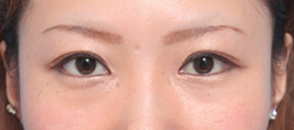 目頭切開,目頭切開の症例 蒙古襞が発達して目と目が離れていた20代女性,After（メイクあり）<br/>
（1ヶ月後）,