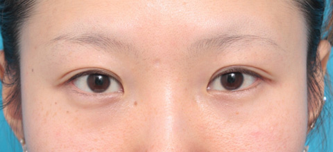 目頭切開,目頭切開の症例 蒙古襞が発達して目と目が離れていた20代女性,施術前,mainpic_megashira02a.jpg