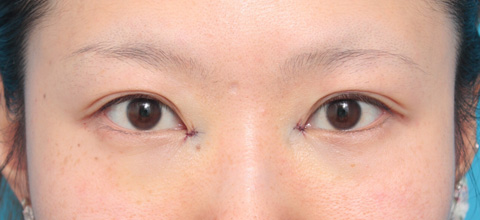 目頭切開,目頭切開の症例 蒙古襞が発達して目と目が離れていた20代女性,施術直後,mainpic_megashira02b.jpg