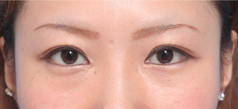 目頭切開,目頭切開の症例 蒙古襞が発達して目と目が離れていた20代女性,1ヶ月後,メイクあり,mainpic_megashira02e.jpg