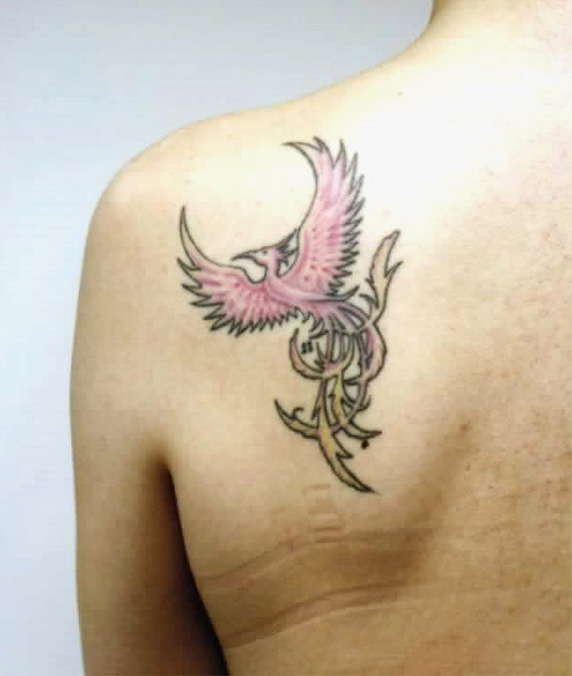 刺青（タトゥー）除去,背中の大きな入れ墨（刺青）を剥削手術で1回で除去した症例写真,Before,ba_irezumi36_b.jpg