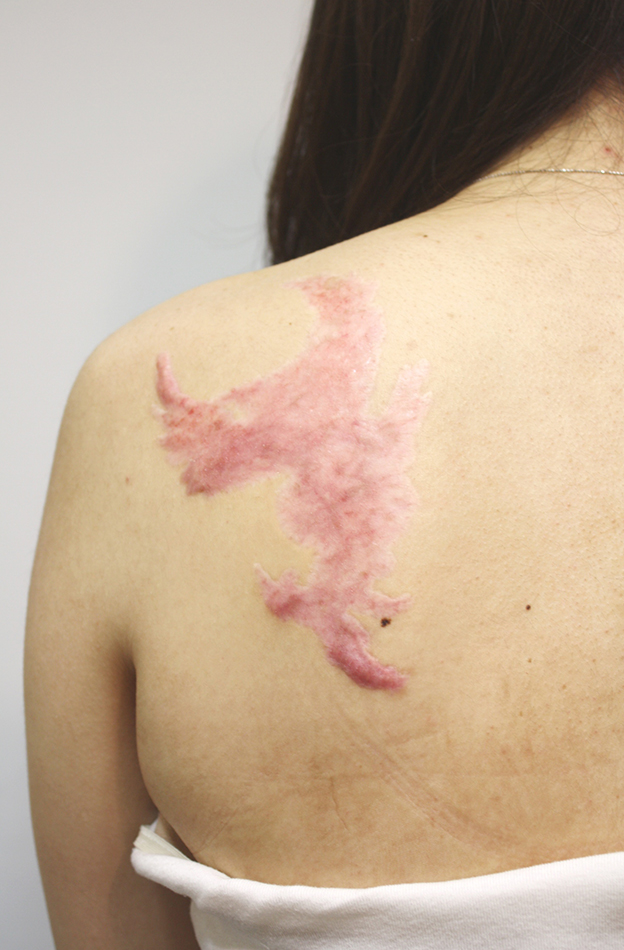 刺青（タトゥー）除去,背中の大きな入れ墨（刺青）を剥削手術で1回で除去した症例写真,6ヶ月後,mainpic_irezumi20e.jpg