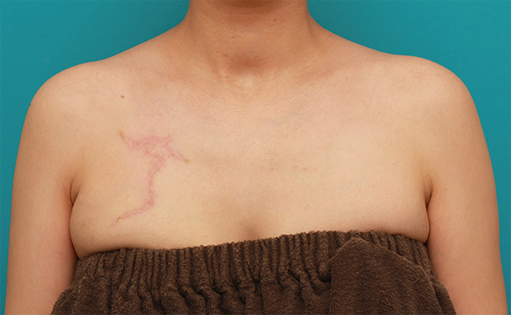 刺青（タトゥー）除去,バストの上の入れ墨を1回で切除縫縮手術した症例写真,After（6ヶ月後）,ba_irezumi37_b.jpg