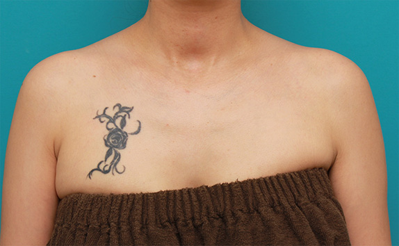 バストの上の入れ墨を1回で切除縫縮手術した症例写真,Before,ba_irezumi37_b.jpg
