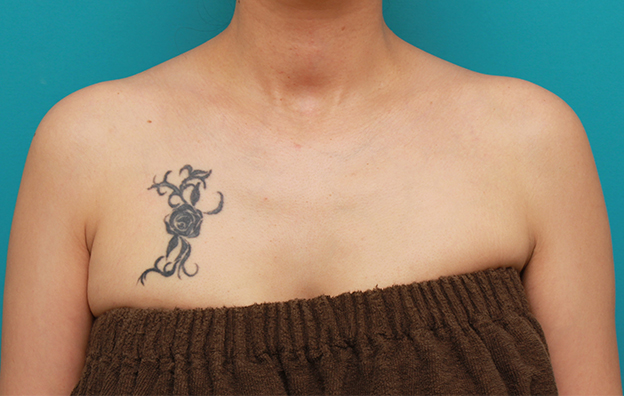 刺青（タトゥー）除去,バストの上の入れ墨を1回で切除縫縮手術した症例写真,手術前,mainpic_irezumi21a.jpg