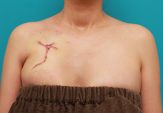 刺青（タトゥー）除去,バストの上の入れ墨を1回で切除縫縮手術した症例写真,手術直後,mainpic_irezumi21b.jpg