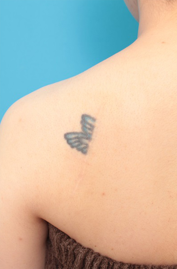 刺青（タトゥー）除去の症例 背部の入れ墨の除去を希望された30代女性,After（1年後）,ba_irezumi38_a01.jpg