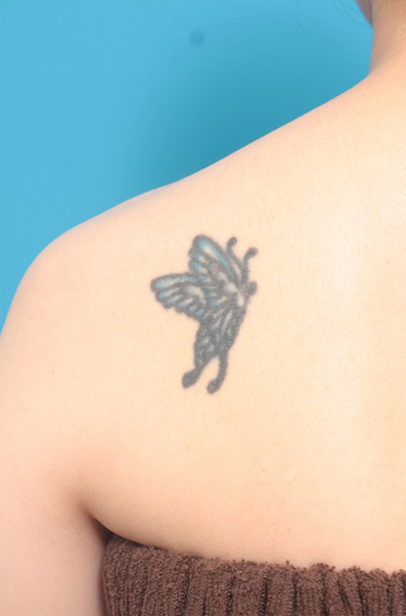 刺青（タトゥー）除去,刺青（タトゥー）除去の症例 背部の入れ墨の除去を希望された30代女性,Before,ba_irezumi38_b.jpg