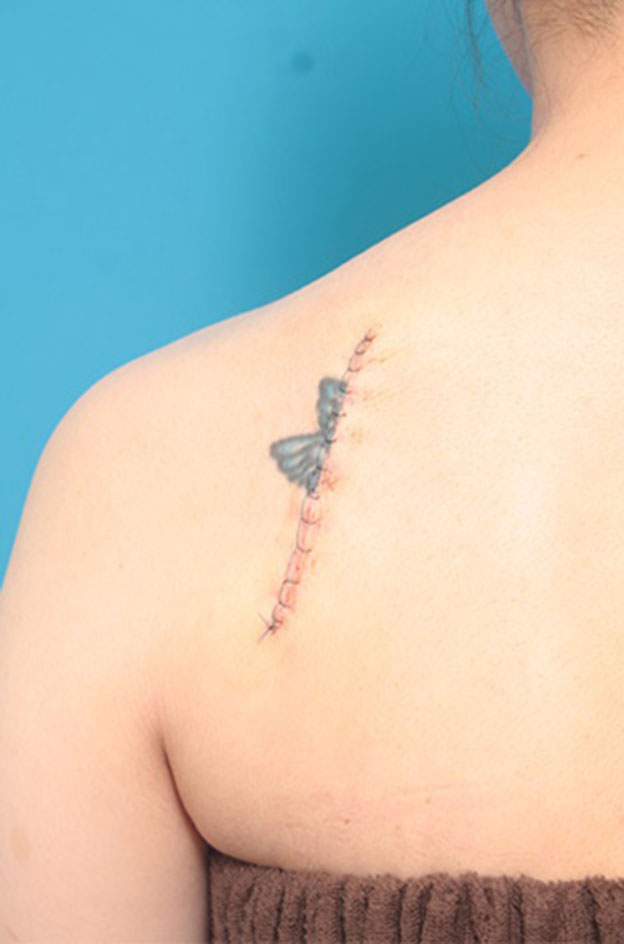 症例写真,刺青（タトゥー）除去の症例 背部の入れ墨の除去を希望された30代女性,手術直後,mainpic_irezumi22b.jpg