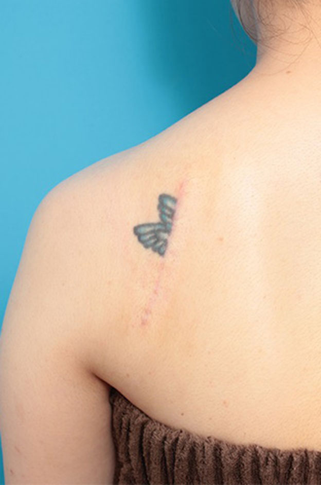 刺青（タトゥー）除去,刺青（タトゥー）除去の症例 背部の入れ墨の除去を希望された30代女性,3ヶ月後,mainpic_irezumi22d.jpg