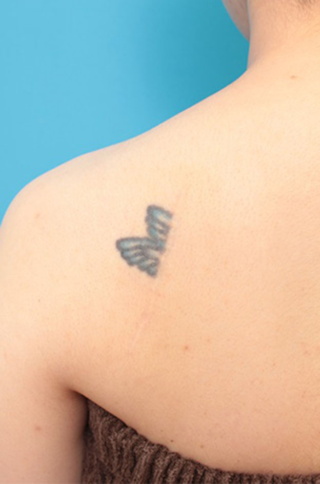 症例写真,刺青（タトゥー）除去の症例 背部の入れ墨の除去を希望された30代女性,1年後,mainpic_irezumi22e.jpg