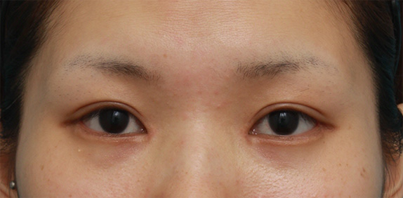 症例写真,目頭切開+目尻切開+タレ目形成+眼瞼下垂手術で目を一周り大きくした症例写真,After（2ヶ月後）,ba_megashira23_b.jpg