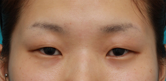 目頭切開,目頭切開+目尻切開+タレ目形成+眼瞼下垂手術で目を一周り大きくした症例写真,Before,ba_megashira23_b.jpg