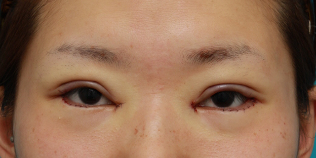 垂れ目（パンダ目）形成（グラマラスライン／下眼瞼下制術）,目頭切開+目尻切開+タレ目形成+眼瞼下垂手術で目を一周り大きくした症例写真,手術直後,mainpic_megashira06b.jpg