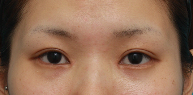 垂れ目（パンダ目）形成（グラマラスライン／下眼瞼下制術）,目頭切開+目尻切開+タレ目形成+眼瞼下垂手術で目を一周り大きくした症例写真,2ヶ月後,mainpic_megashira06d.jpg